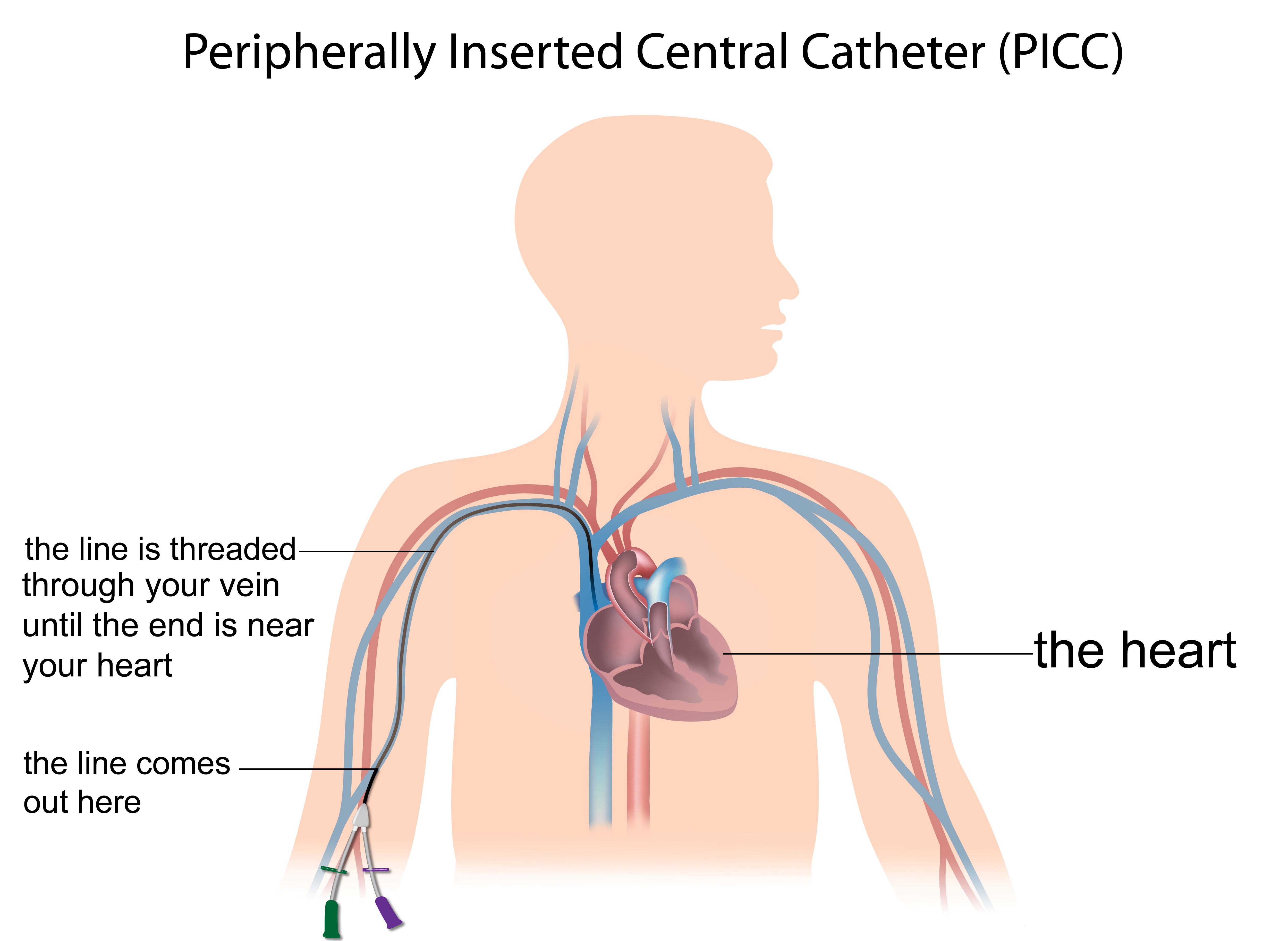 An illustrated diagram showing a person's silhouette in pale pink and tubes running up the person's arm on the left, leading to the heart. The captions read: "The line comes out here (indicating a place on the upper arm). The line is threaded through the vein until the end is near your heart." On the right side of the diagram, the heart is labelled.